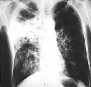 Hình phim X-quang của một bệnh nhân bệnh lao, ảnh chụp trước đây.